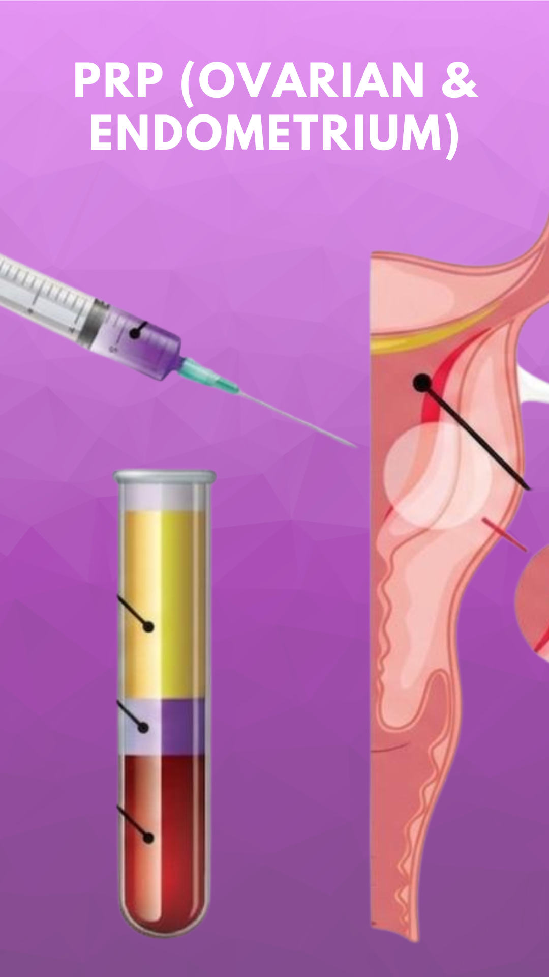PRP therapy for ovarian and endometrial rejuvenation at GHRACE & HOPE IVF to support fertility treatment and improve reproductive health.